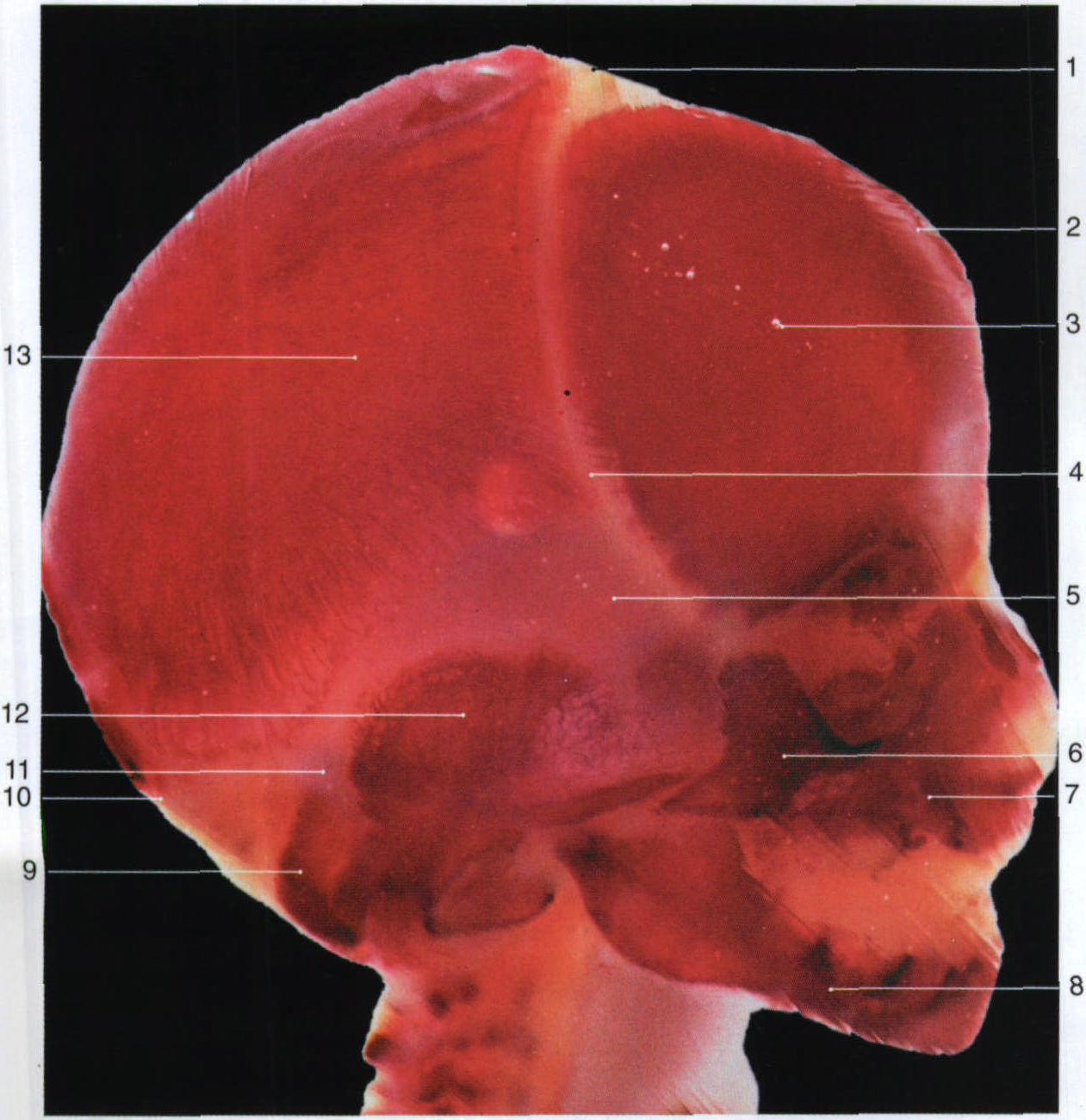8. 胎儿透明颅骨(侧面观)